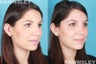 Revision Rhinoplasty