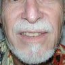 Male Nose Cancer Reconstruction