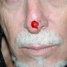 Male Nose Cancer Reconstruction