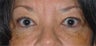 Female Eyelid Surgery