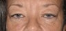Female Eyelid Surgery