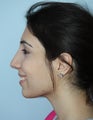 18 year old seeking functional and cosmetic rhinoplasty