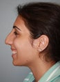 18 year old seeking functional and cosmetic rhinoplasty