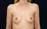 Breast Augmentation