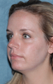 Fraxel Dual Laser Treatment