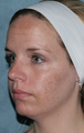 Fraxel Dual Laser Treatment