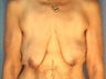 Breast Lift