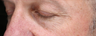 Treatment of facial veins