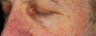 Treatment of facial veins