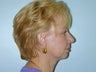 55 year old woman who was unhappy with the appearance of her neck.