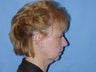 55 year old woman who was unhappy with the appearance of her neck.