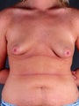 Breast Lift with Breast Augmentation