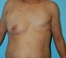 Left DIEP Flap Breast Reconstruction with Right Periareolar Breast Lift