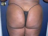 Buttock Augmentation