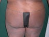 Buttock Augmentation