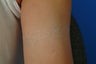 QSR Ruby Laser Tattoo Removal