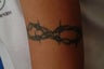 QSR Ruby Laser Tattoo Removal