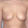 Breast Implants