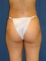Brazilian Butt Lift