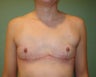 FTM "Top Surgery"