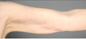 Smart Lipo: Upper Arm Area