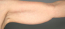 Smart Lipo: Upper Arm Area