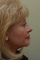 Facelift (Profile View)