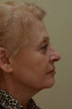 Facelift (Profile View)