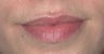 Lip Augmentation