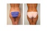Vaser liposuction