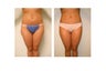 Vaser liposuction