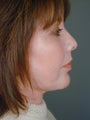 Female Chin Implant