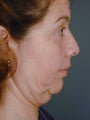 Female Chin Implant