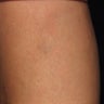 Before and After Cosmetic Vein Sclerotherapy of Leg Veins