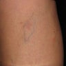Before and After Cosmetic Vein Sclerotherapy of Leg Veins