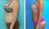 Liposuction Before & After