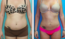 Liposuction Before & After