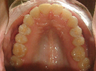 Invisalign treatment for crowded teeth with a cross-bite