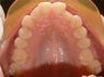 Invisalign treatment for crowded teeth with a cross-bite