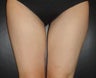 SmartLipo MPX