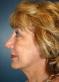 Nose Surgery