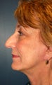 Nose Surgery