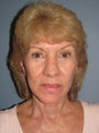 This 62-year-old woman had a LiteLift™, Temple Lift, and Blue Peel®