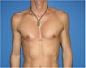 Pectoral Augmentation, Pec Implants