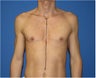 Pectoral Augmentation, Pec Implants