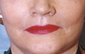 Lip Augmentation