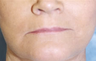 Lip Augmentation