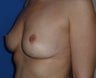 Breast Lift