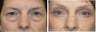 Upper and Lower Blepharoplasty with a Facelift rejuvenate this 50+ Female