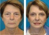 Upper and Lower Blepharoplasty with a Facelift rejuvenate this 50+ Female